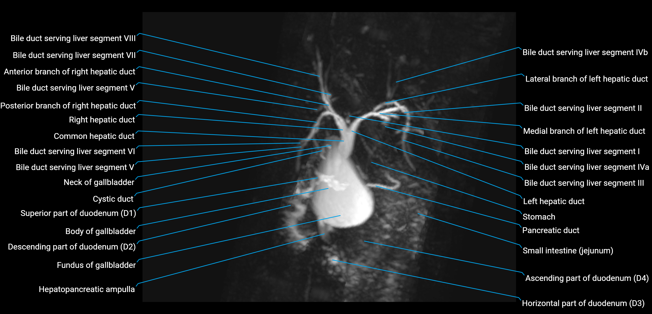 MRCP MIP MRI  anatomy labelled image-img-01003-00018.png